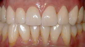 After upper arch rehabilitation with porcelain crowns