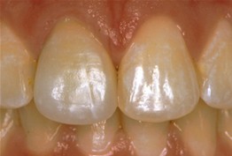 Before porcelain crown treatment