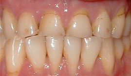 Before upper arch rehabilitation