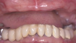 After upper arch rehabilitation front view