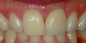 Before single tooth replacement