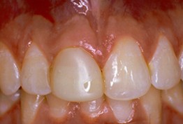 After porcelain crown treatment