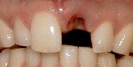 After single dental implant and porcelain crown