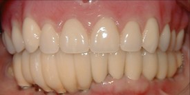 After upper and lower arch rehabilitation
