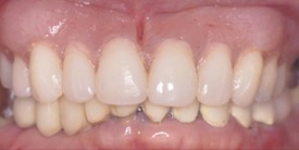 Before upper and lower arch rehabilitation